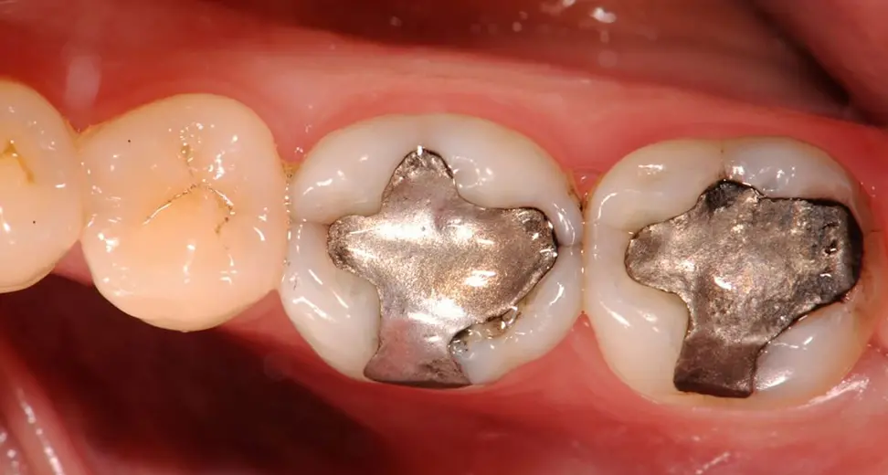 Fermati due ladri dopo un furto, in auto avevano 268 denti d'oro: denunciati per ricettazione