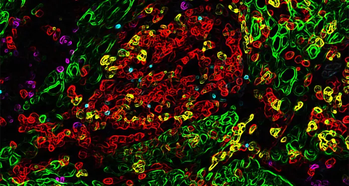 Cellule tumorali, la speranza arriva da una scoperta dell’Università di Trento