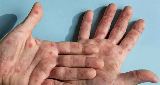 Vaiolo delle scimmie (monkey pox) in calo, per i vaccini ed i comportamenti delle comunità omosessuali maschili