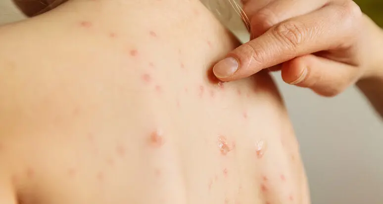 Morbillo, aumento del 3.000 per cento dei casi in Europa e Asia centrale da gennaio