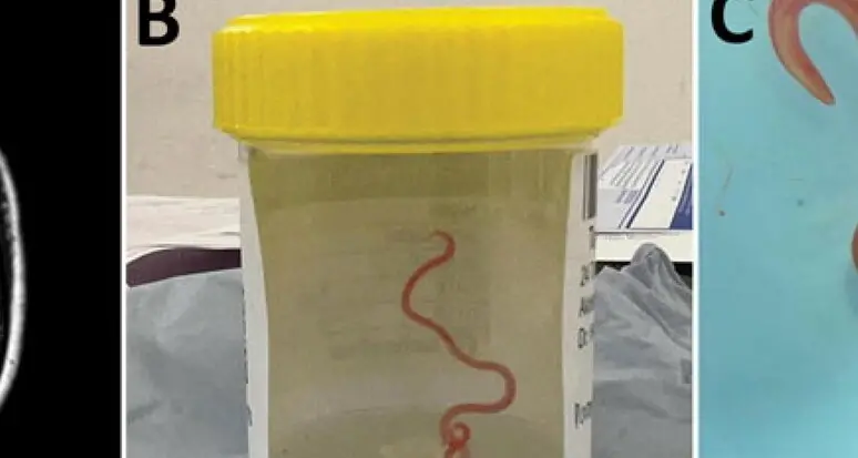 Aveva febbre e depressione: era un verme nel cervello, un nematode di 8 centimetri che si trova nei pitoni