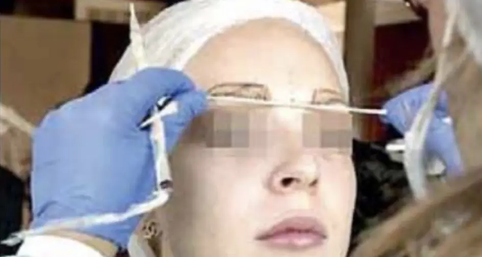 La sentenza: viso cambiato dopo il tattoo l'estetista deve risarcire